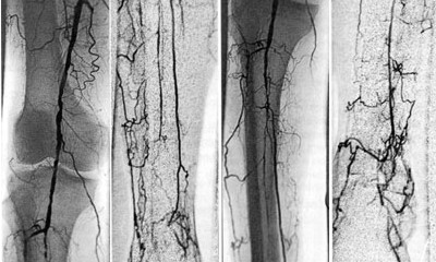 Arteriografia de Miembros Pelvicos Inferiores