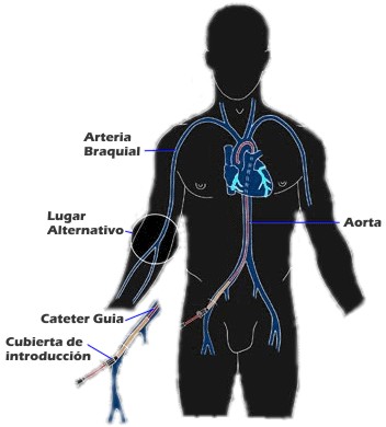 Sitios de cateterizaci�n