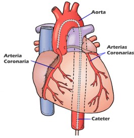 Corazon cateterizado