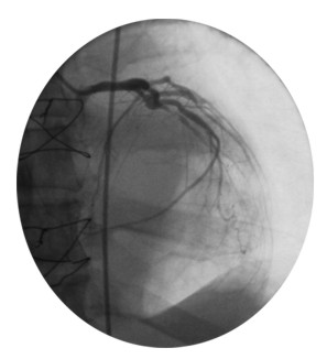Medio de contrastes en Coronarias