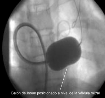 Valvuloplastia con bal�n Inoue