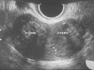 Mioma Uterino