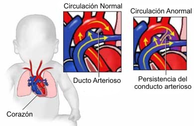 Persitencia del conducto arterioso