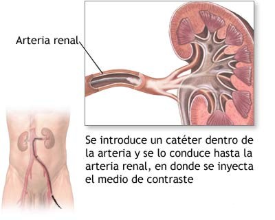Arteriografia Renal