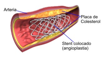 Stent colocado