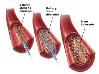 Stenting